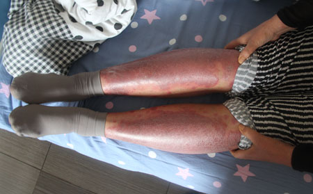 腿上有很多红点是不是牛皮癣