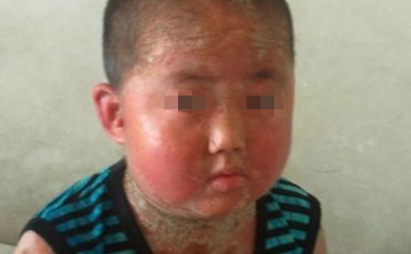 青少年银屑病患者有哪些症状？