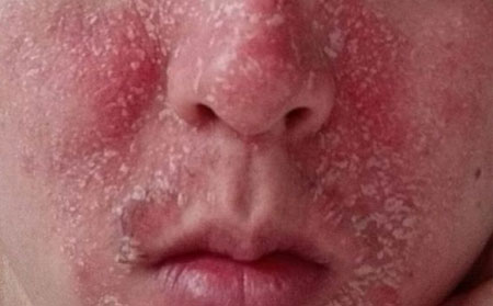 牛皮癣的症状需要重视