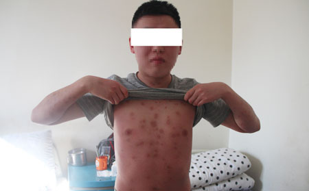 牛皮癣消退有什么症状