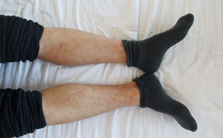 银屑病患者在夏季怎样对自身的疾病进行护理?