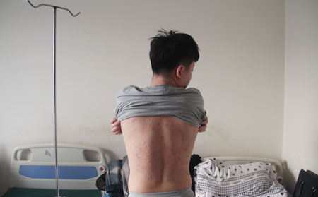 牛皮癣对人们有什么影响