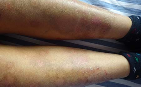 潍坊男性银屑病治疗多久可以恢复