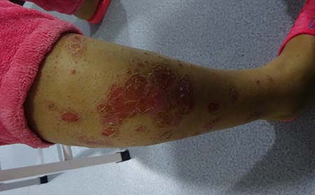 儿童银屑病患者治疗难点是什么
