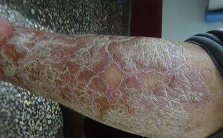 女性得了银屑病要怎么办呢