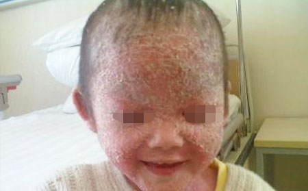 家长如何对儿童银屑病患者进行护理