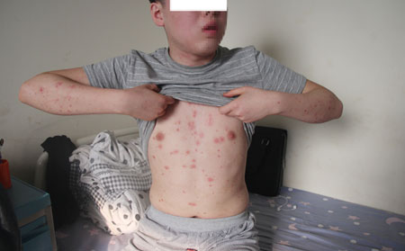 女性银屑病患者生理期要注意什么呢?