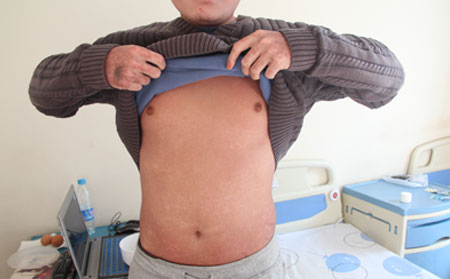 孩子得了脓包型银屑病如何治治疗效果果 可以?