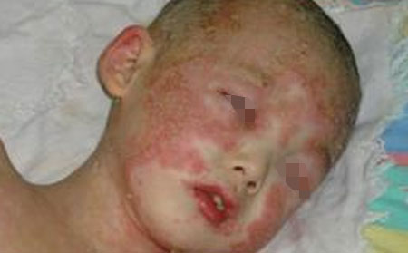 孩子得了银屑病是什么原因造成的?