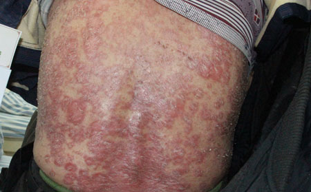 男性牛皮癣给患者带来哪些损害？