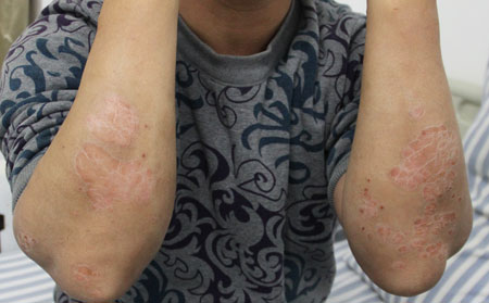 男性银屑病患者为什么不能吸烟?