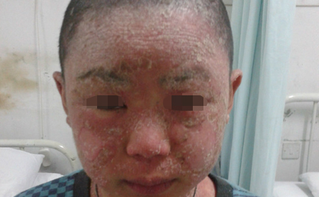女性银屑病日常要注意什么?