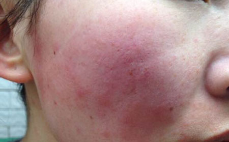 女性银屑病患者怎样防治？