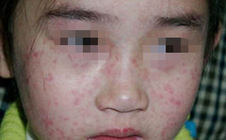 女性银屑病患者怀孕期间有哪些注意事项?