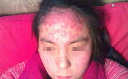 银屑病孕妇怎样对自身的病情进行护理?