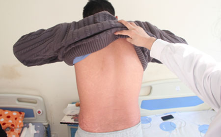 男性银屑病患者出汗多会产生不良影响吗?