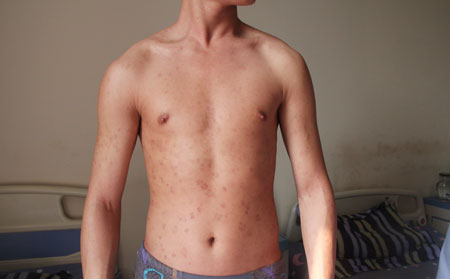 男性银屑病发病高的原因有什么?