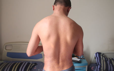 男性银屑病有哪些显著症状?