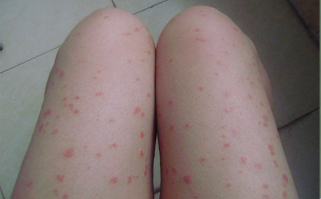 女性牛皮癣患者什么时候 适合怀孕?