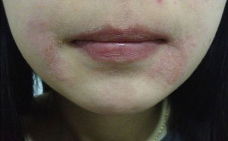 女性牛皮癣患者美容的办法有哪些呢