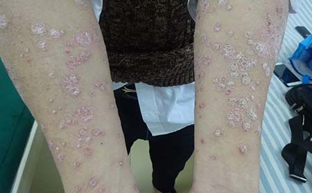 女性牛皮癣患者怀孕