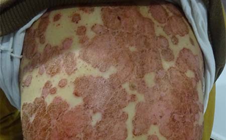 潍坊治银屑病要做哪些检查