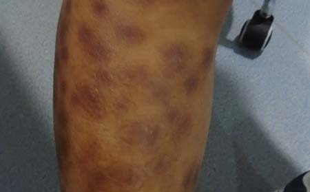 潍坊银屑病银屑病怎么治疗