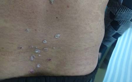 潍坊治疗银屑病潍坊银屑病怎样治疗好