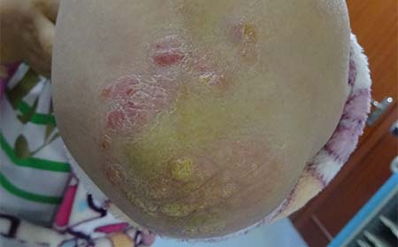 潍坊银屑病怎样治疗好