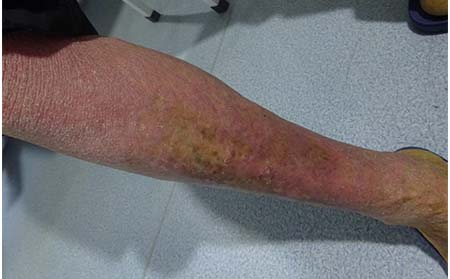 潍坊牛皮癣治疗多少钱牛皮癣发病率高