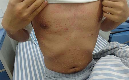 潍坊哪里治牛皮癣比较好中医治疗银屑病