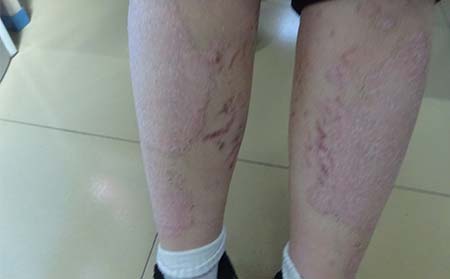 潍坊女性银屑病,银屑病症状