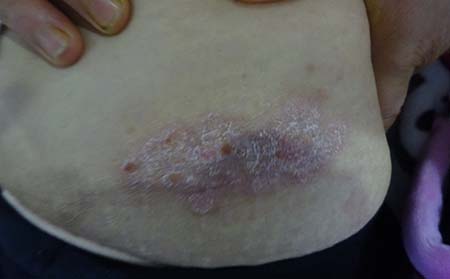 银屑病吃什么药好?潍坊牛皮癣医院告诉你