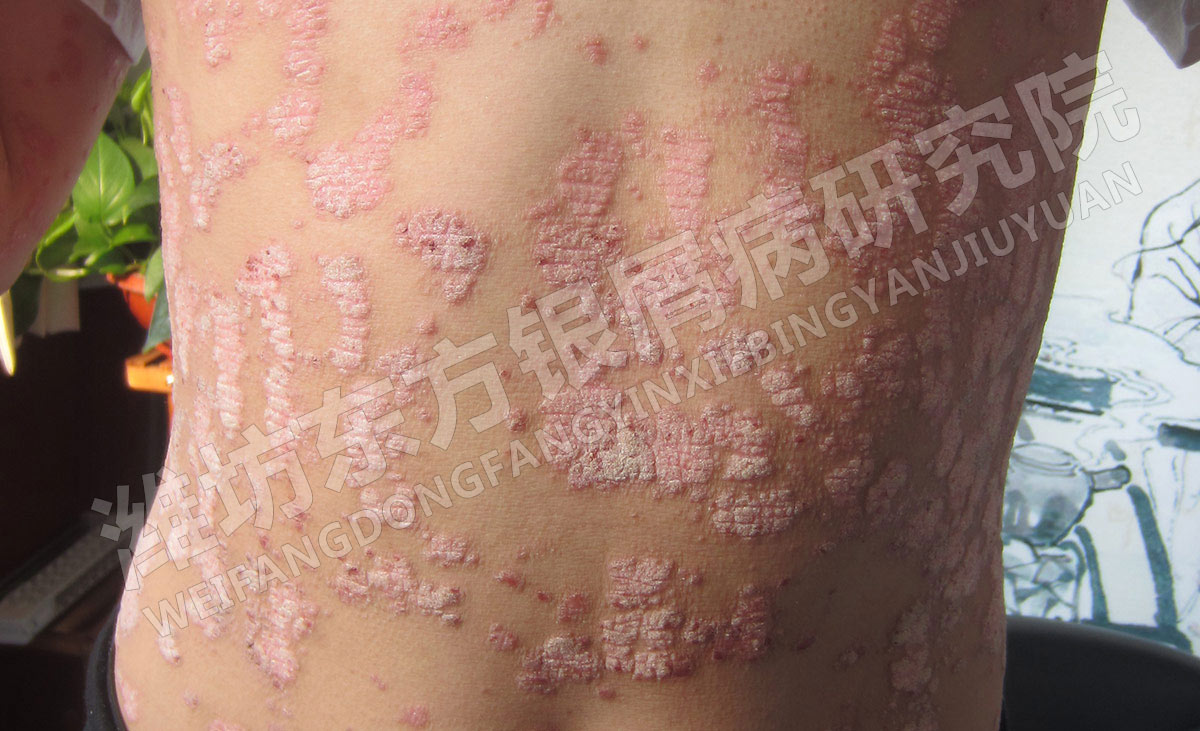女性牛皮癣的症状