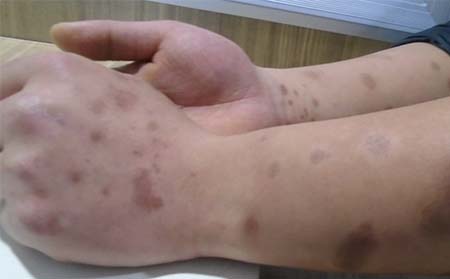 寻常型牛皮癣症状,寻常型牛皮癣有什么症状