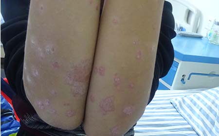 儿童银屑病症状,儿童银屑病症状图片
