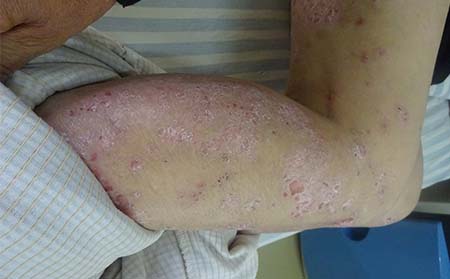 银屑病症状,银屑病症状特征表现