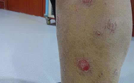 银屑病症状,银屑病快好什么样
