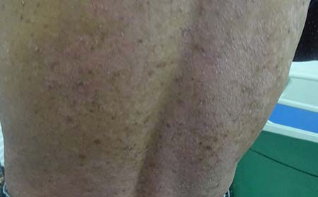 背部牛皮癣症状,背部牛皮癣什么样