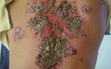 脓疱型银屑病症状,脓疱型银屑病表现