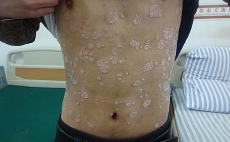 男性银屑病病因,男性为什么得银屑病