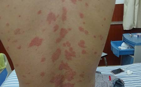 牛皮屑病症状,牛皮屑病什么表现