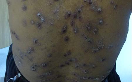 春季银屑病饮食,春季银屑病吃什么