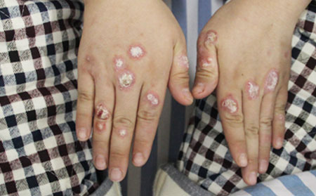 手部银屑病症状,手部银屑病症状图片