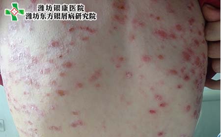 牛皮癣症状表现,牛皮癣会有什么症状