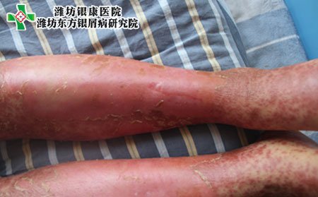 红皮型银屑病护理,老年红皮型银屑病护理