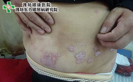 寻常型银屑病症状,寻常型银屑病特点