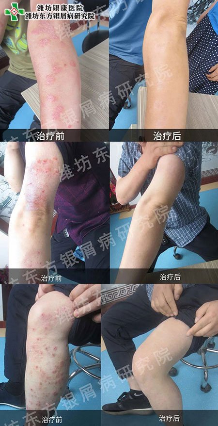 潍坊银屑病医院牛皮癣银屑病治疗康复对比图