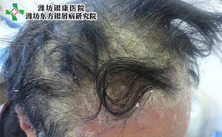头部银屑病症状,头部银屑病表现