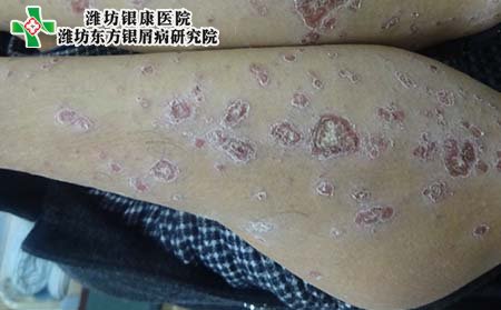 牛皮癣治疗,怎样治牛皮癣效果好